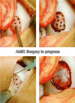 regenerarea cartilajului