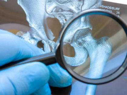 Types of Hip Replacement