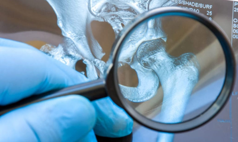 Types of Hip Replacement