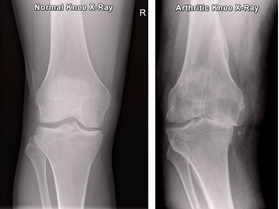 Knee Arthritis Xray