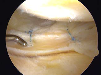 Meniscal repair photo