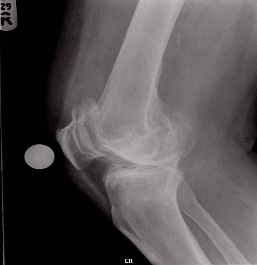 arthritic-knee-xray-2