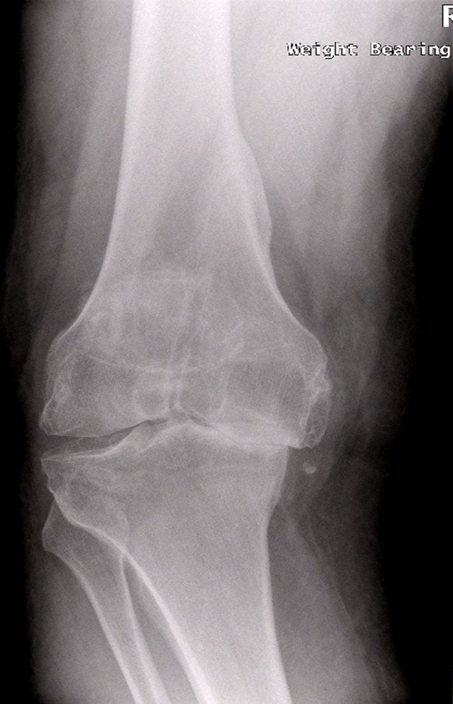 Arthritic Knee Xray