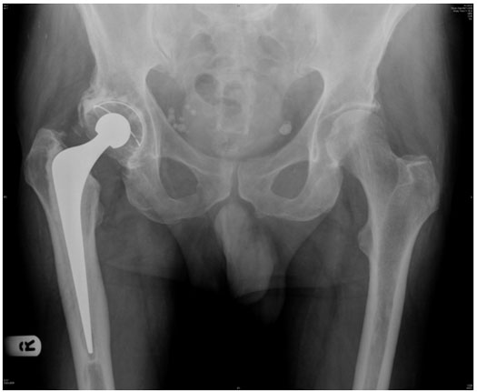 Exeter Hip Replacement