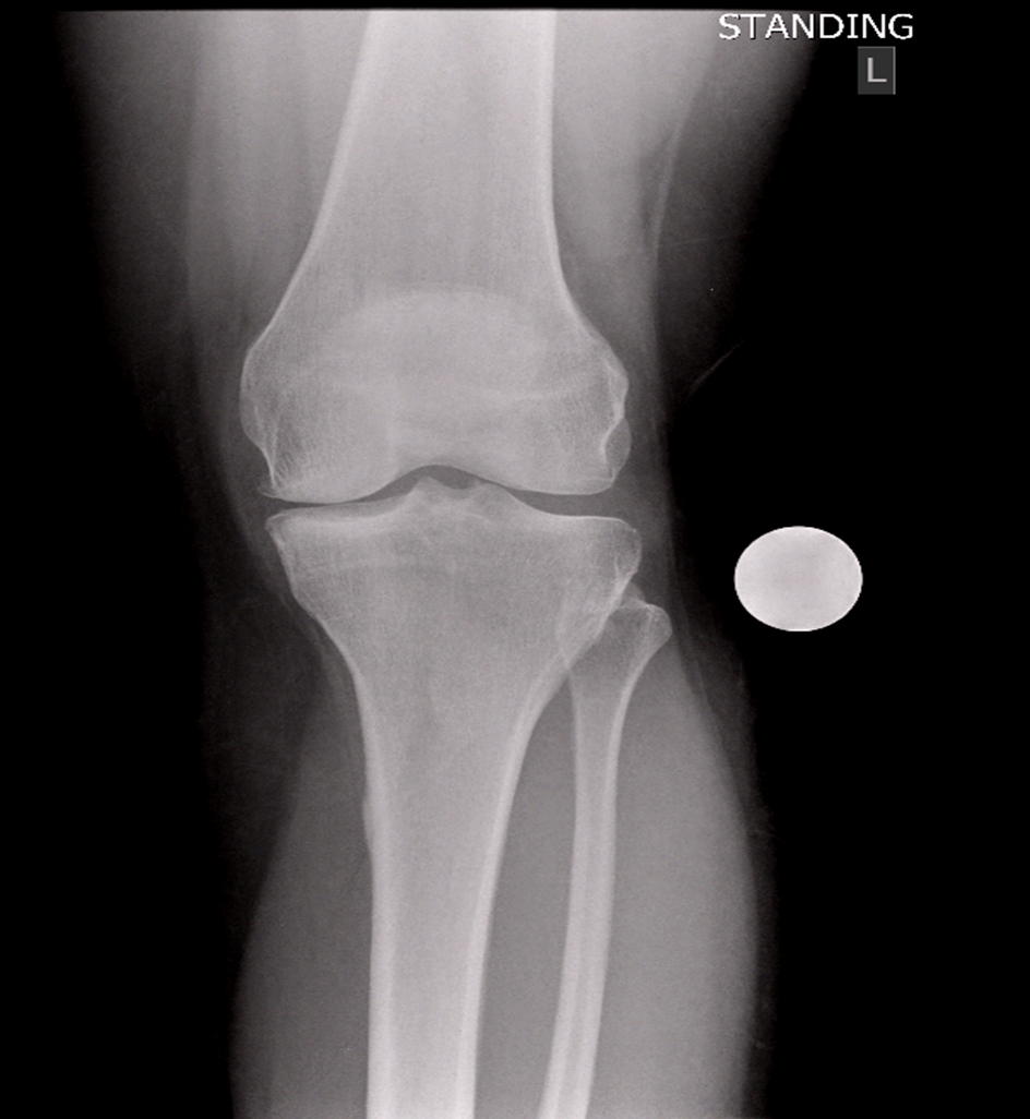 knee-osteotomy-xray1