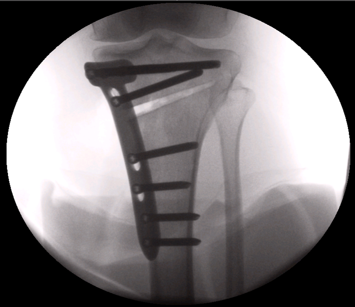Knee Osteotomy X-Ray