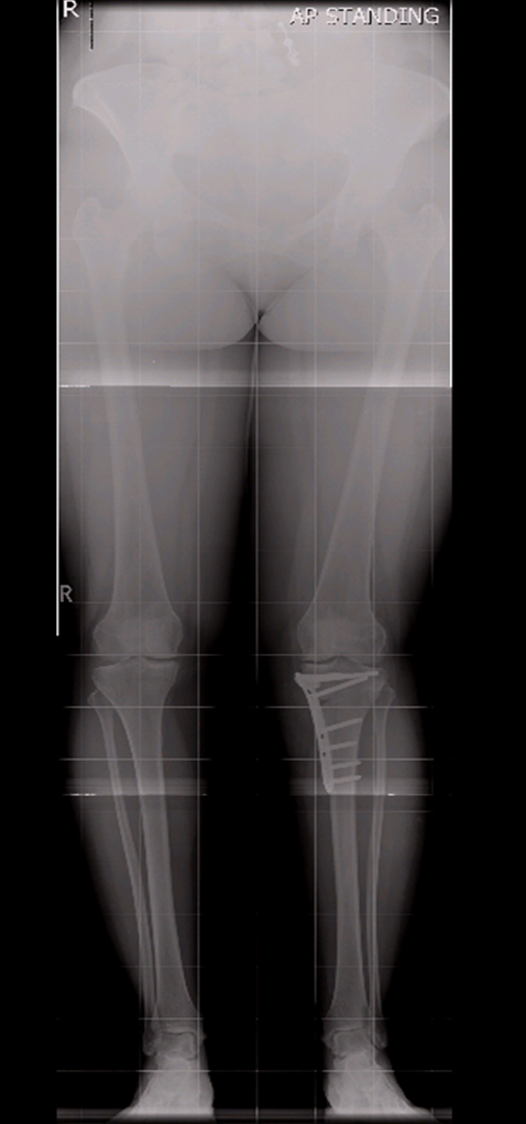 Postoperative X-Ray Views Showing Knee Alighment Adjustment