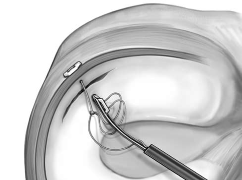 meniscal-repair-diagram