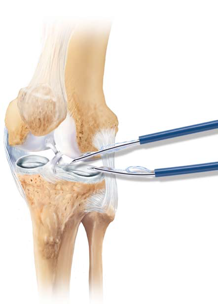 meniscal-repair-instruments