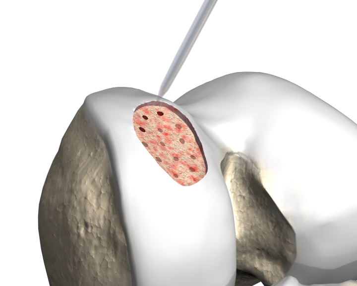 Microfracture