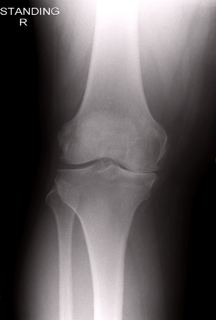 partial-knee-replacement-xray1