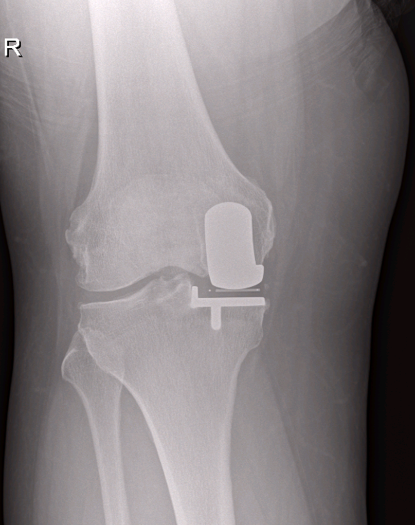 Partial Knee Replacement X-Ray