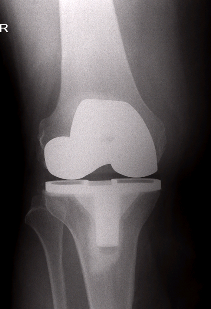 total-knee-repacement-xray2