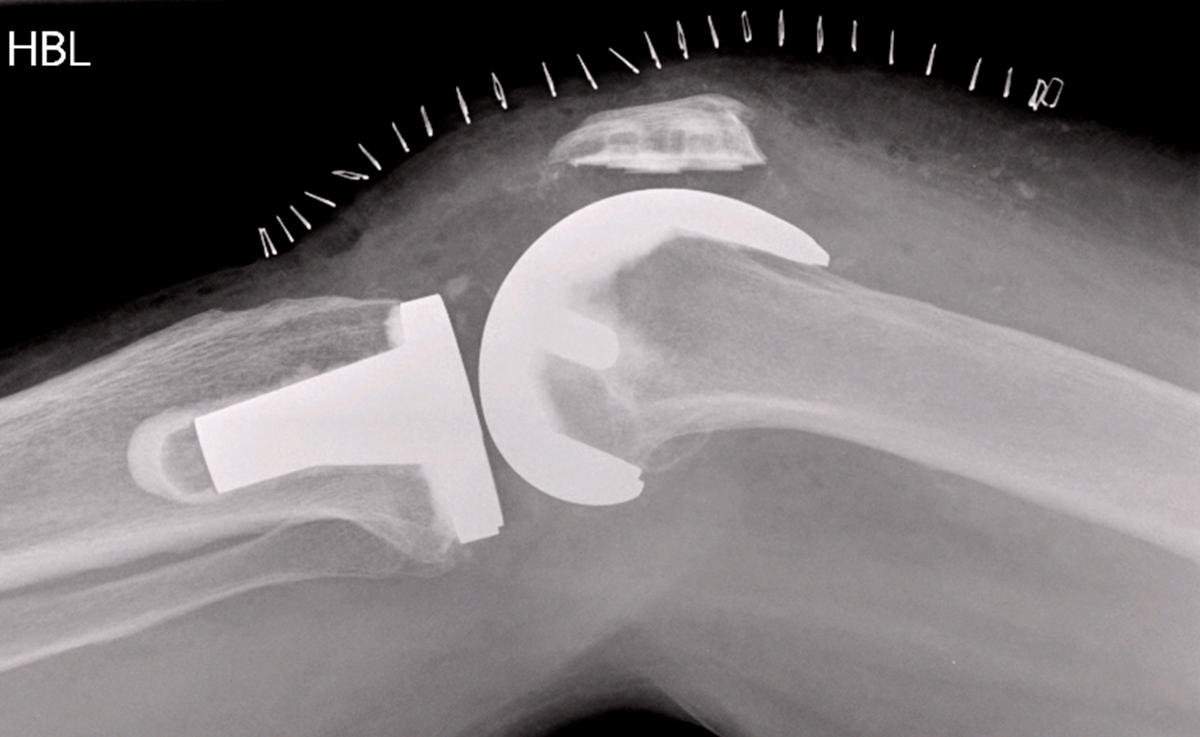 Post-operative X-Ray Total Knee Replacement Surgery
