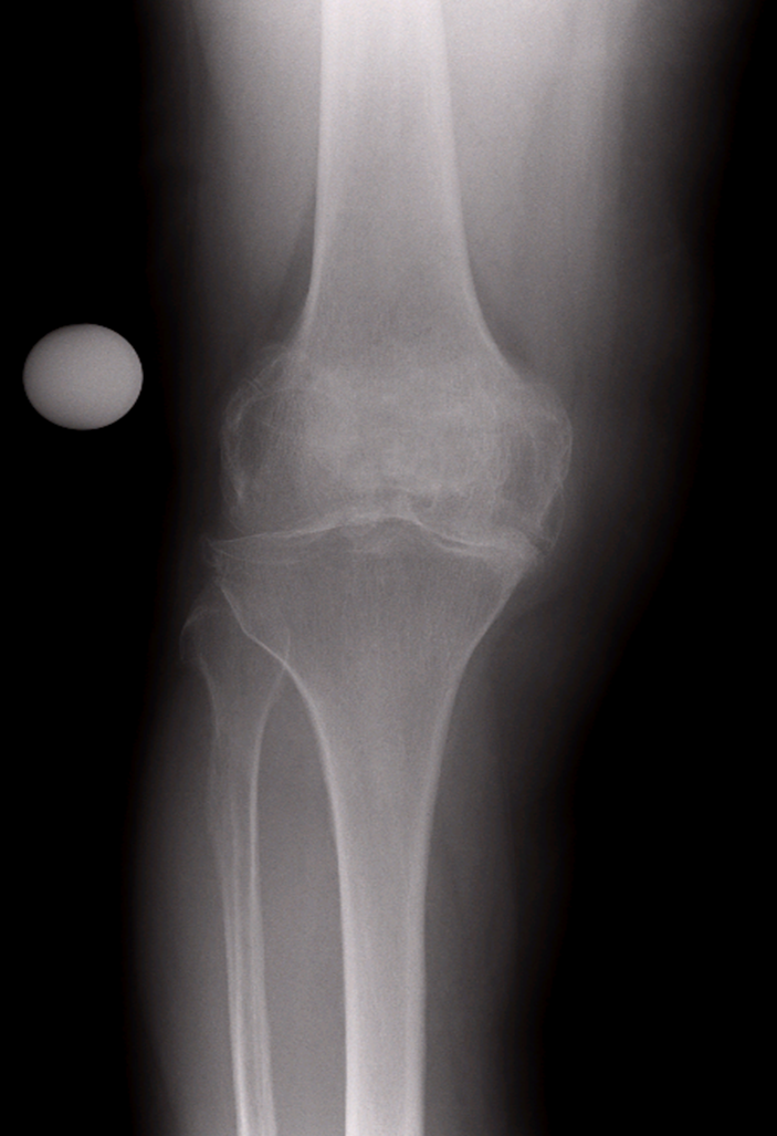 total-knee-replaecment-pre-op-xray