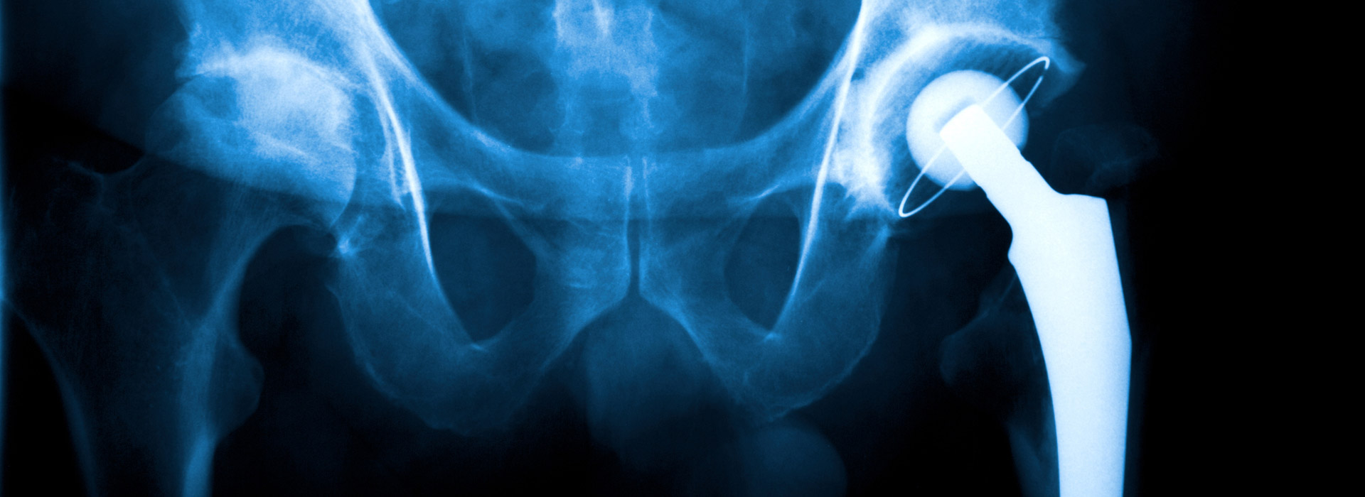 Northampton Hip Replacement Surgery